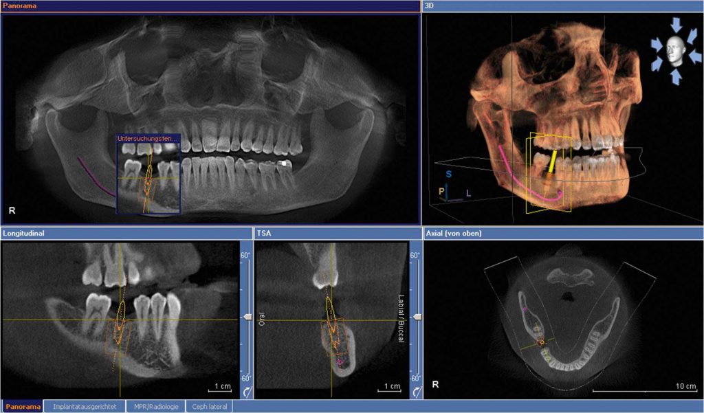 電腦斷層宜蘭植牙