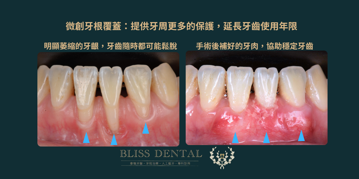 宜蘭牙周病牙齦萎縮