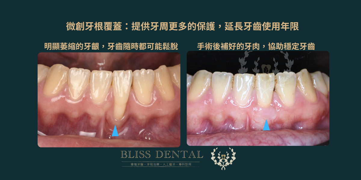 宜蘭牙齦萎縮牙周病黑三角