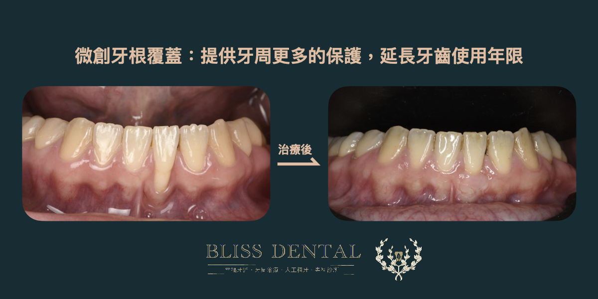 宜蘭牙齦萎縮，可以藉由牙根覆蓋手術改善