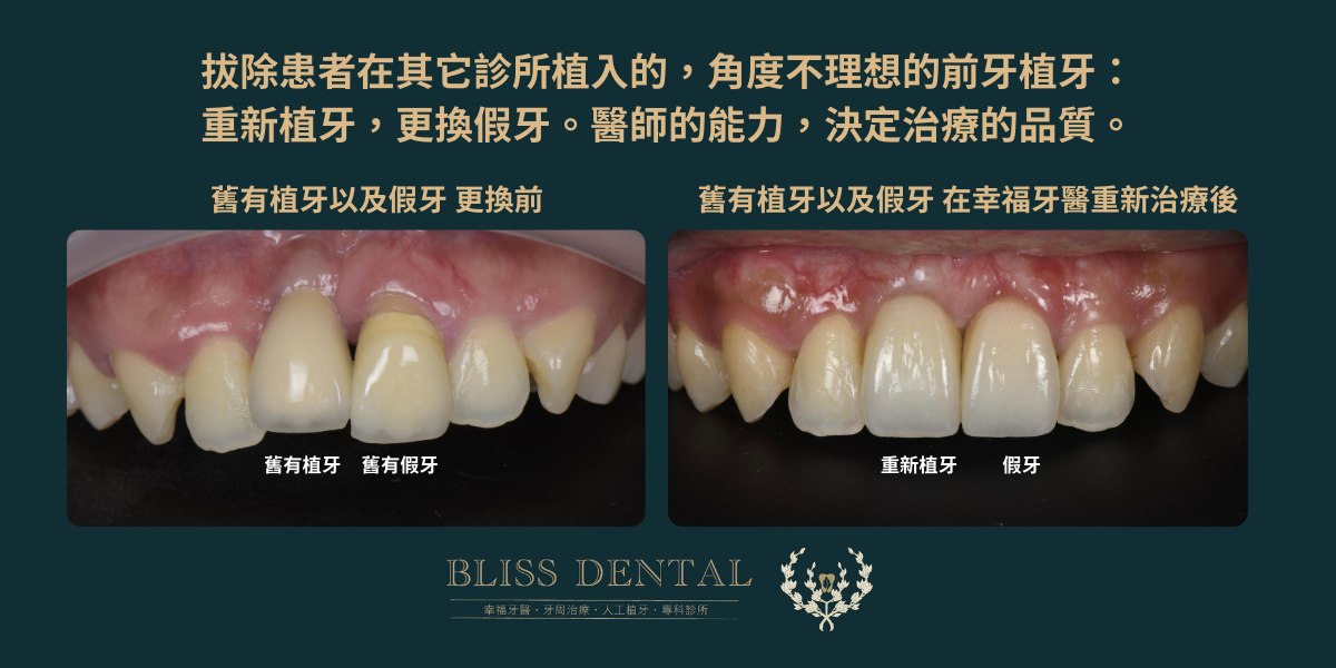 幸福牙醫植牙修復案例