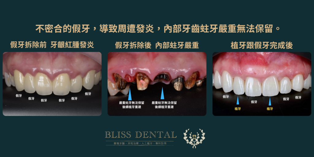 宜蘭植牙牙周病全瓷冠