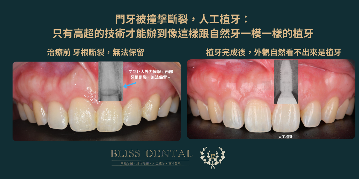 宜蘭幸福牙醫前牙植牙治療後自然笑容成果