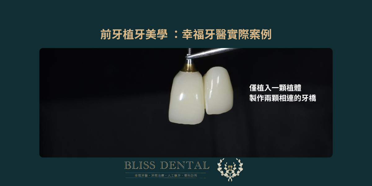 宜蘭門牙植牙推薦